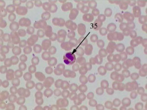 Eosinophils have pink granules and a segmented nucleus