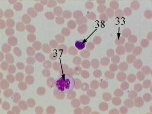 Monocytes are large white blood cells with a bean-shaped nucleus, no granules, and often foamy appearing cytoplasm. Lymphocytes are agranulocytes with round nucleus and a small rim of cytoplasm.